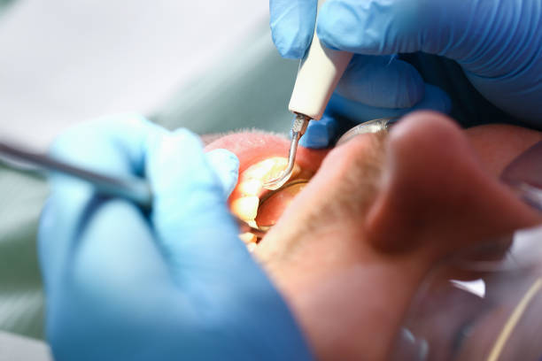 Best Emergency Wisdom Teeth Removal in Andalusia, IL